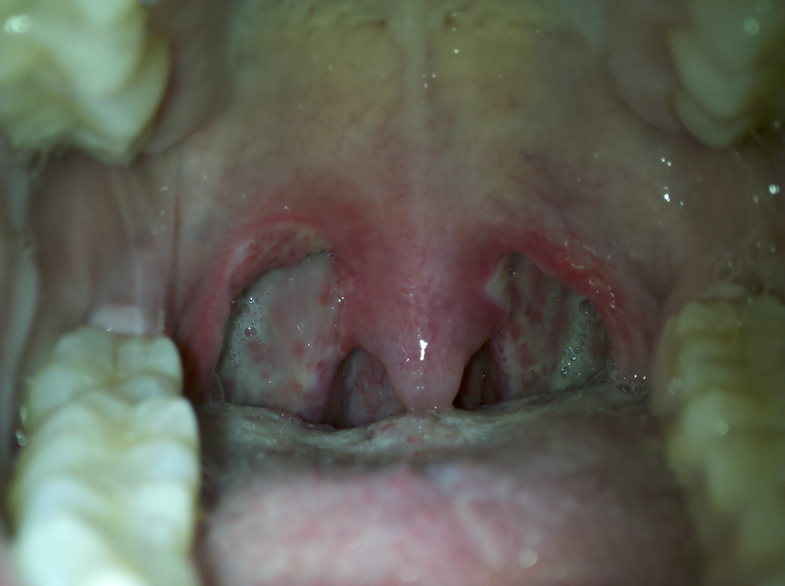 tonsillectomy-picture-day-11-tonsillectomy