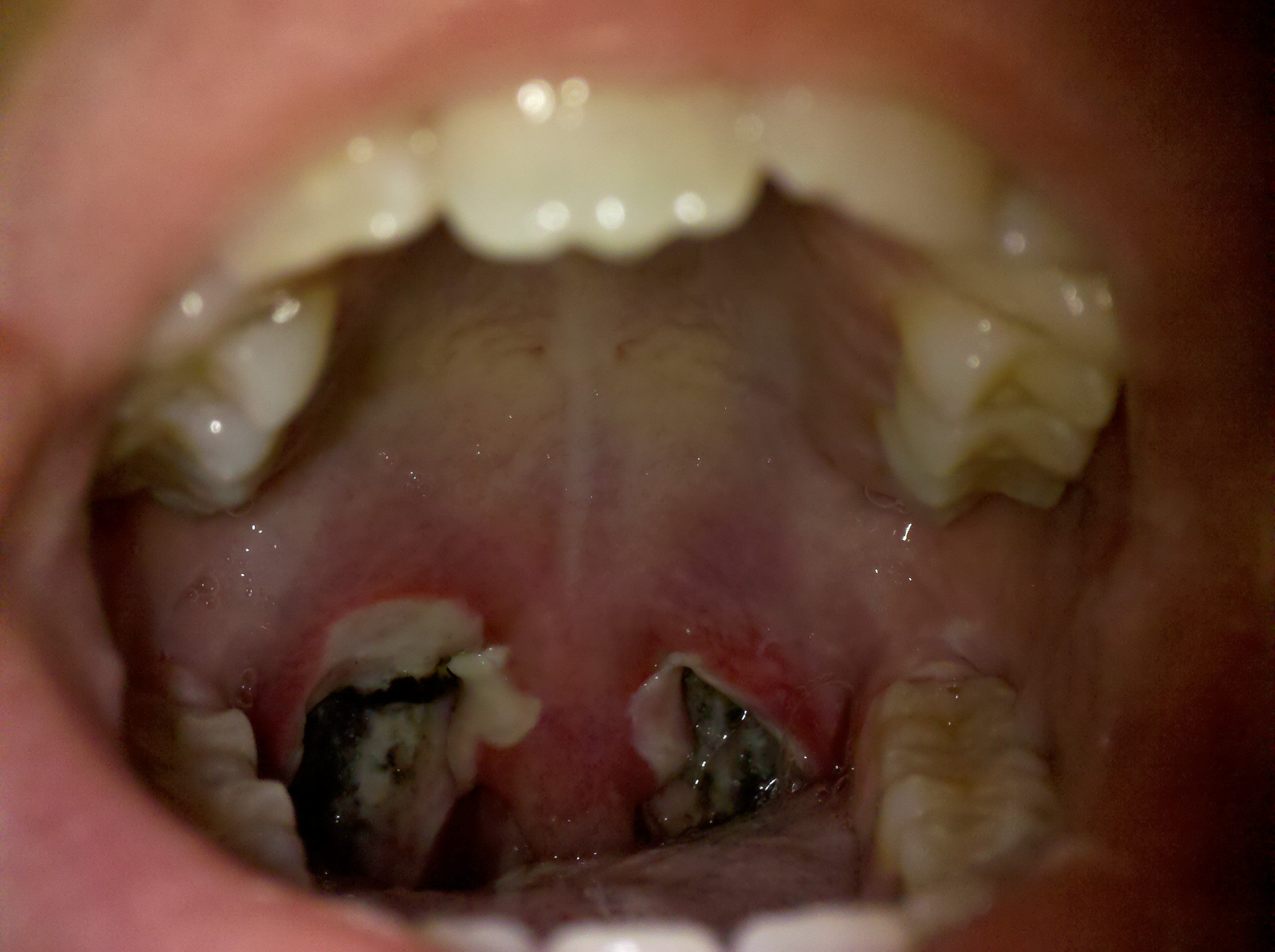 tags-on-tonsils-at-dean-nichols-blog