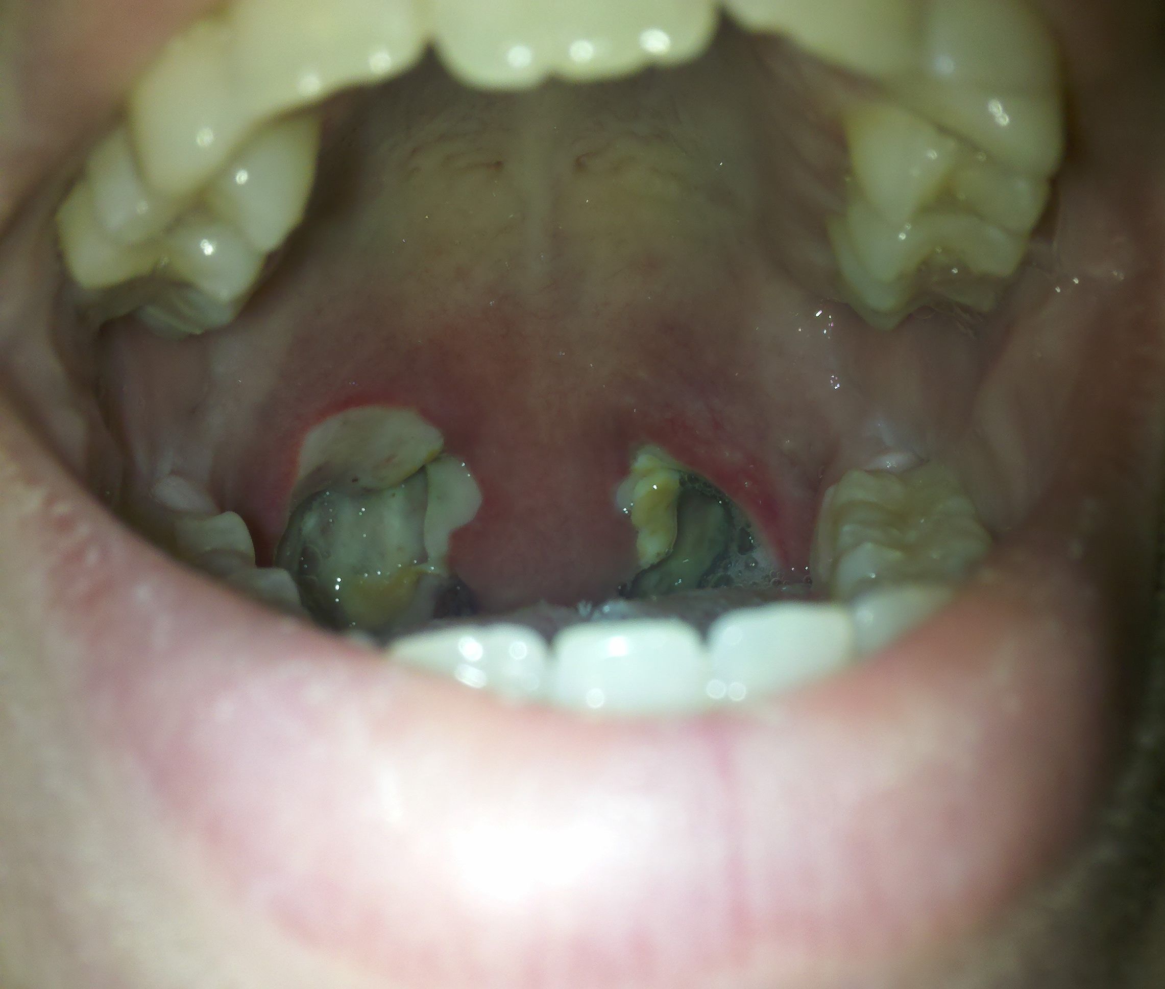 Black Uvula