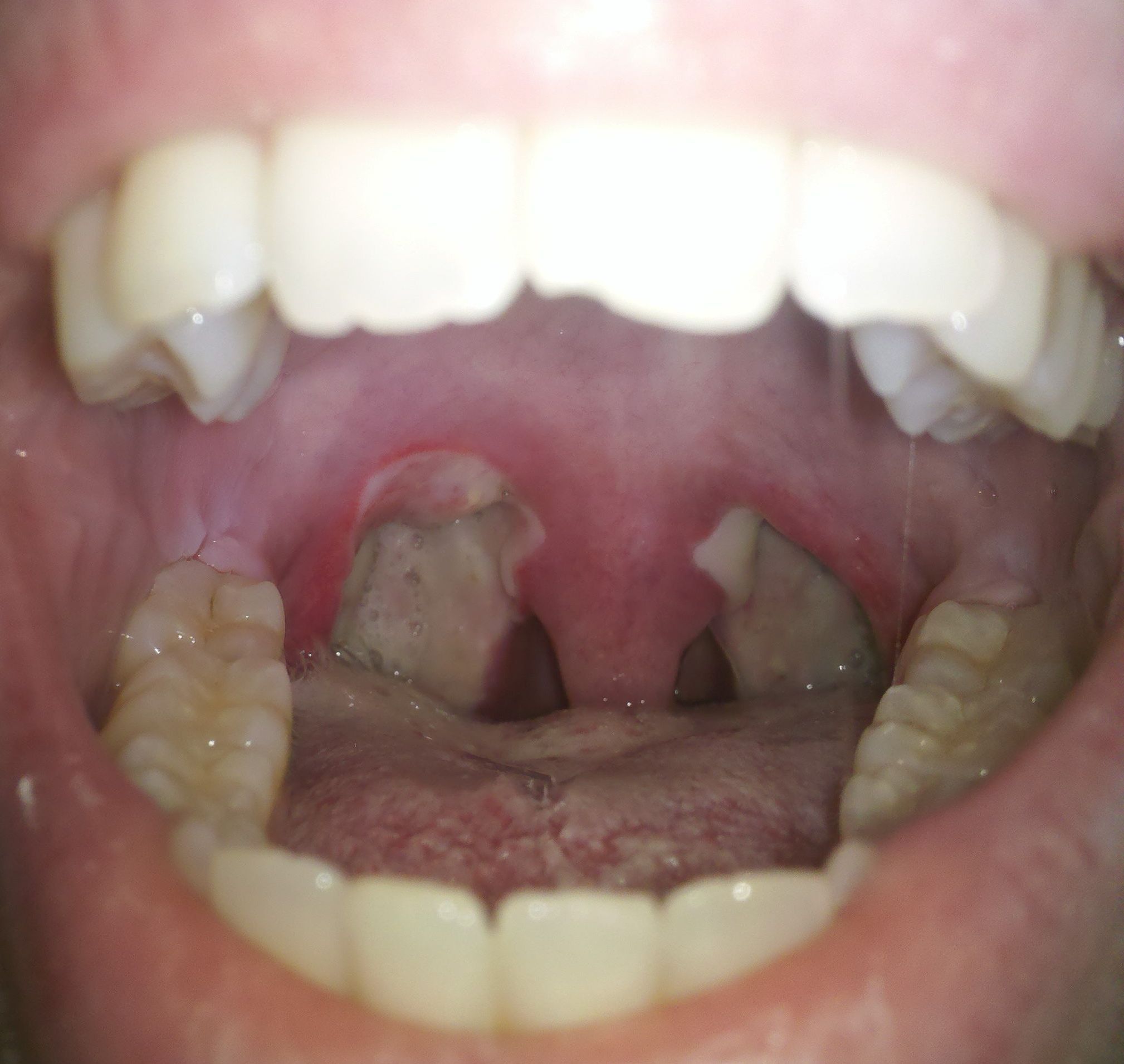 removal-of-tonsils-in-adults-video