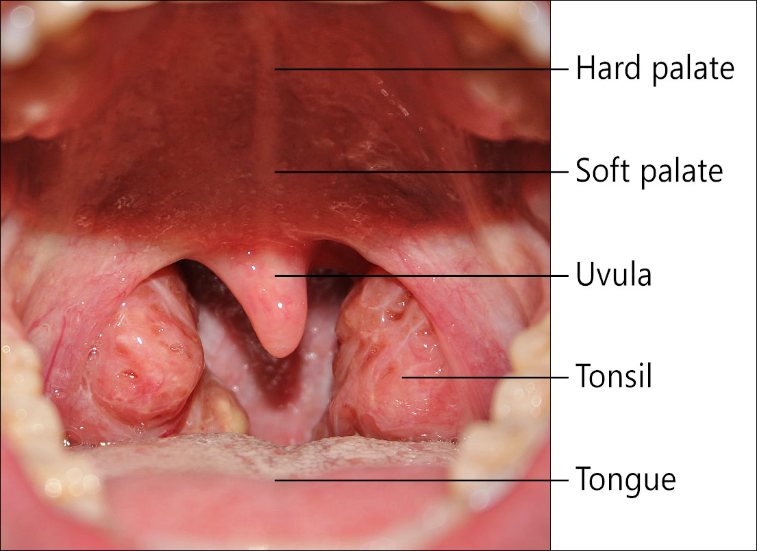 how-to-cure-tonsillitis-fast-and-naturally-youtube