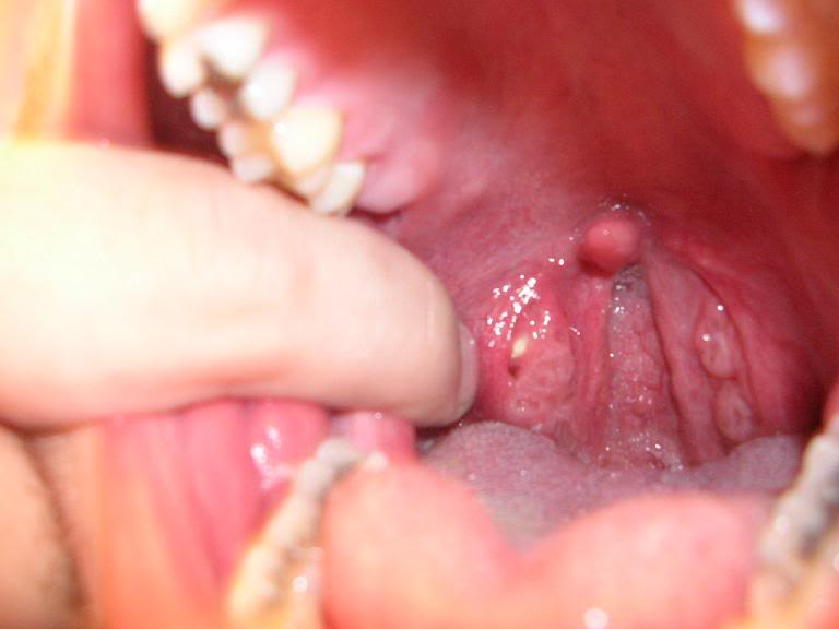 Tonsil Pics