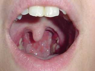 really bad tonsillitis