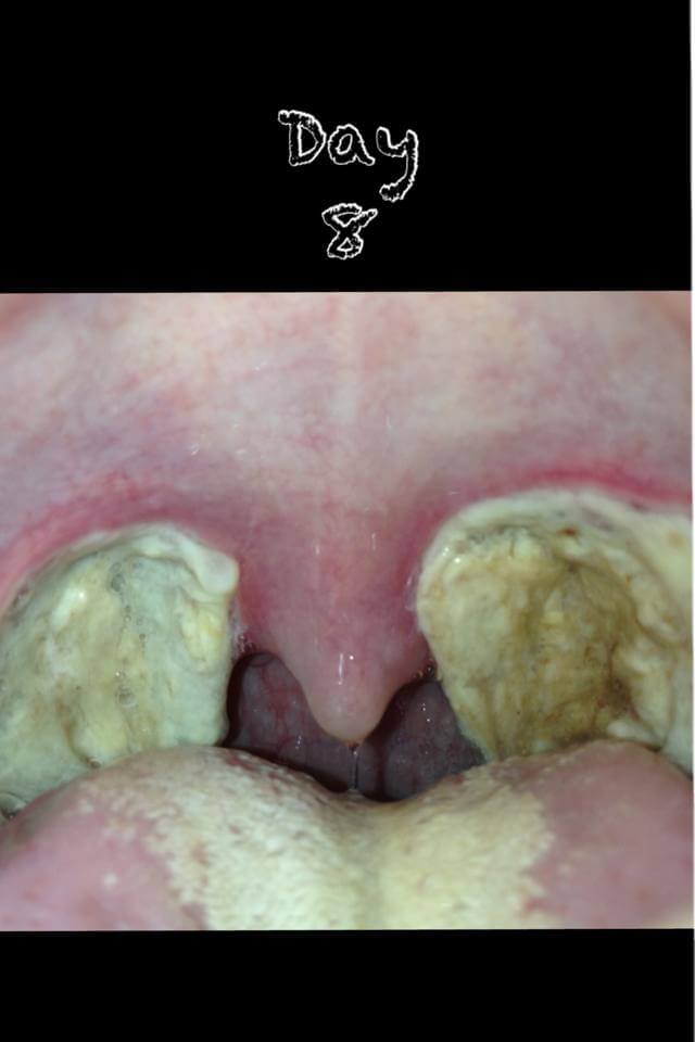 Tonsillectomy Scabs Tonsillectomy