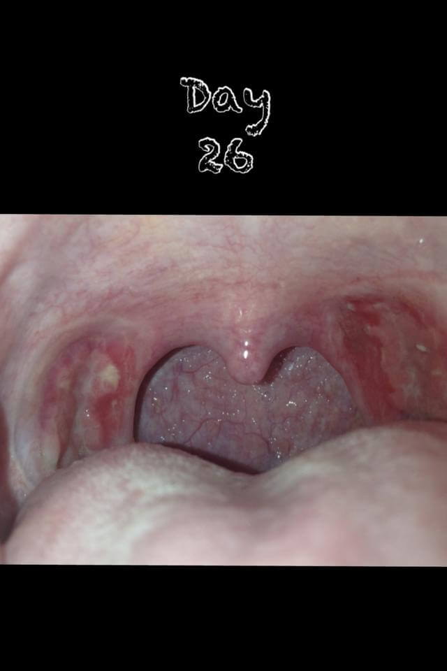 tonsillectomy-and-adenoidectomy-t-a-fort-worth-ent-sinus