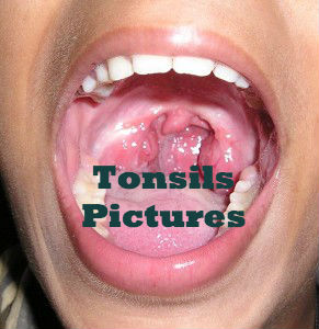 tonsils tonsillectomy