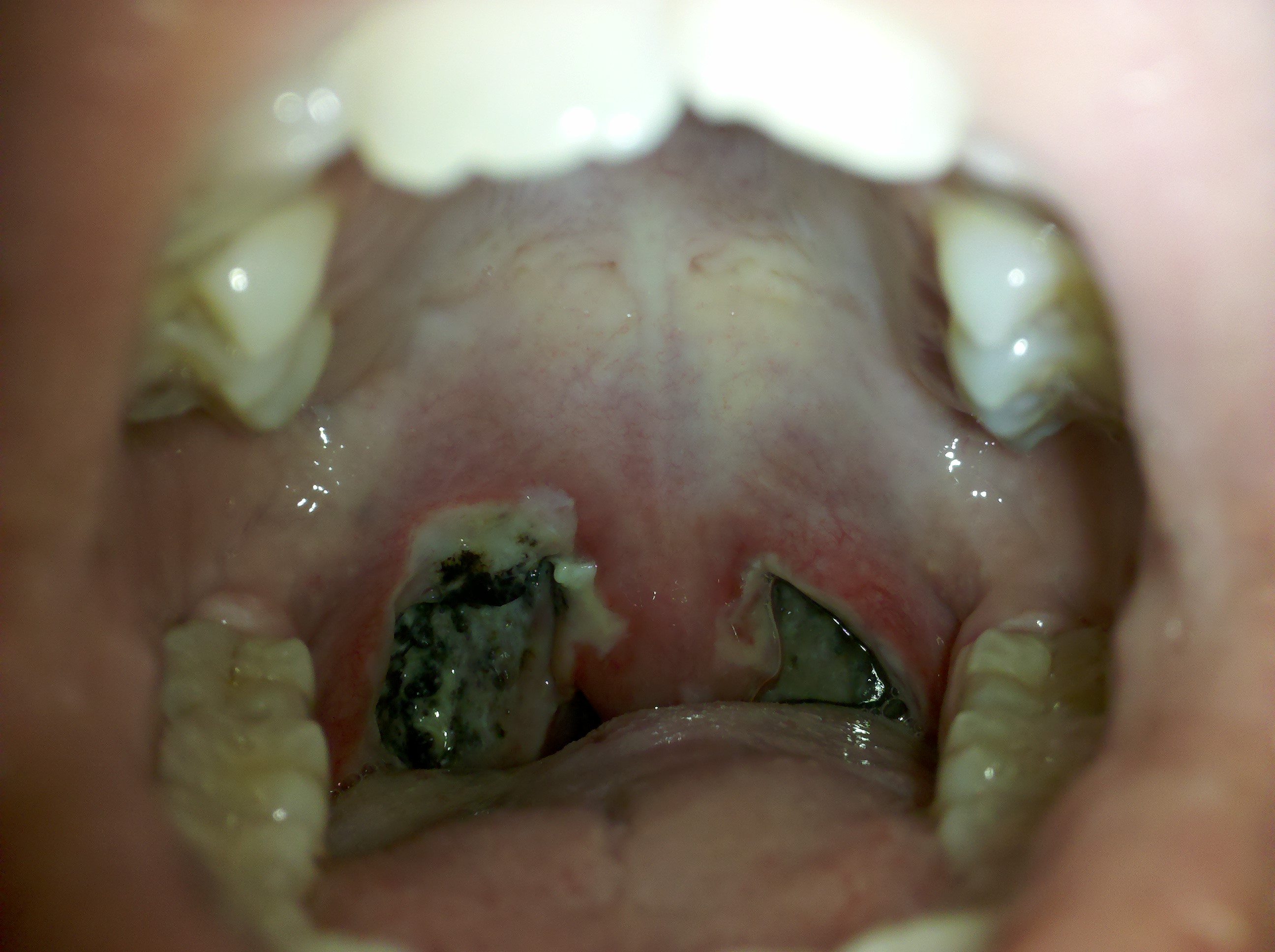 tonsils removed scabs