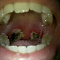 Tonsillectomy Pictures – Tonsillectomy