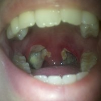 Tonsillectomy Pictures – Tonsillectomy