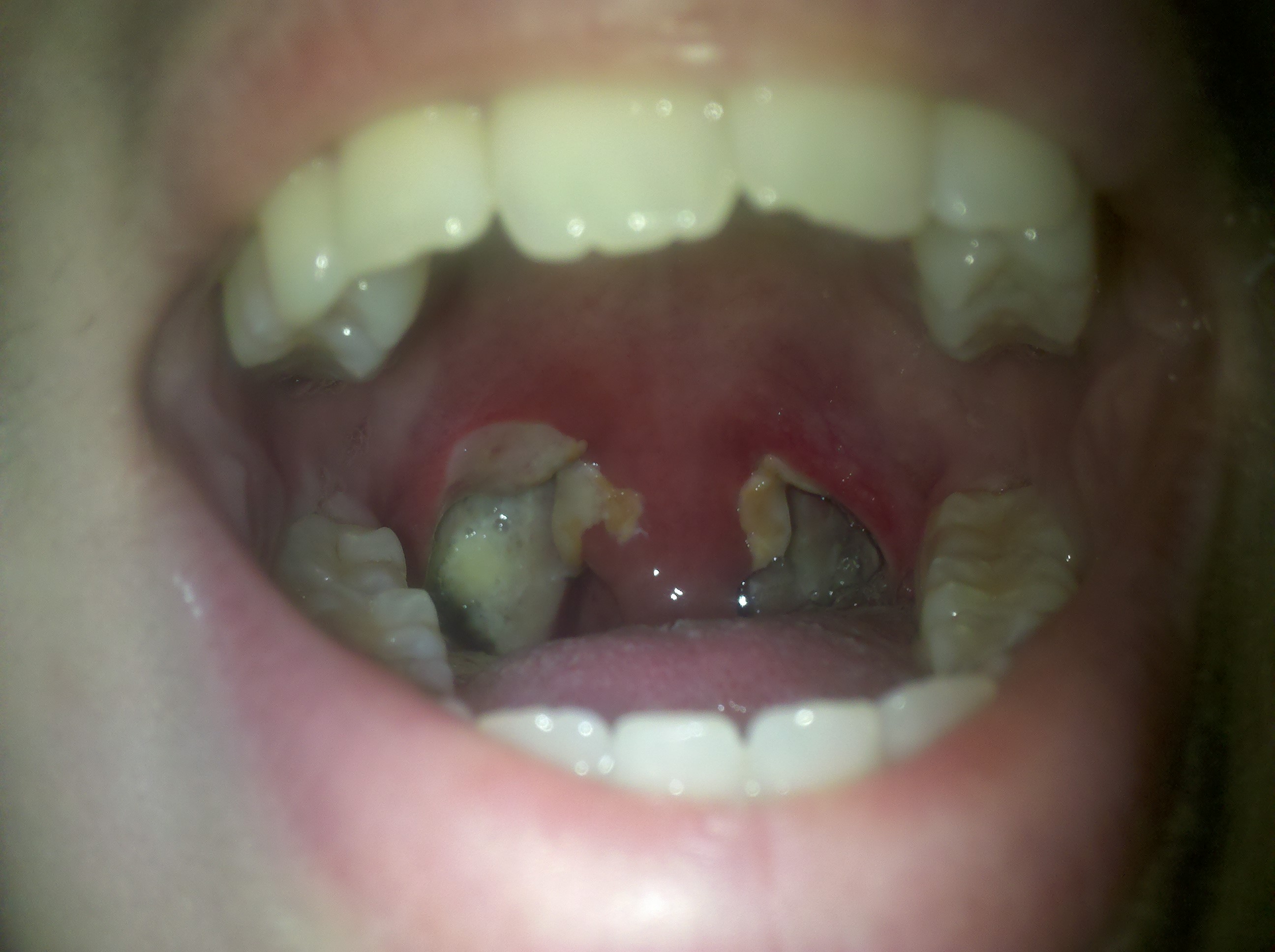 Tonsillectomy Scabs Day 5