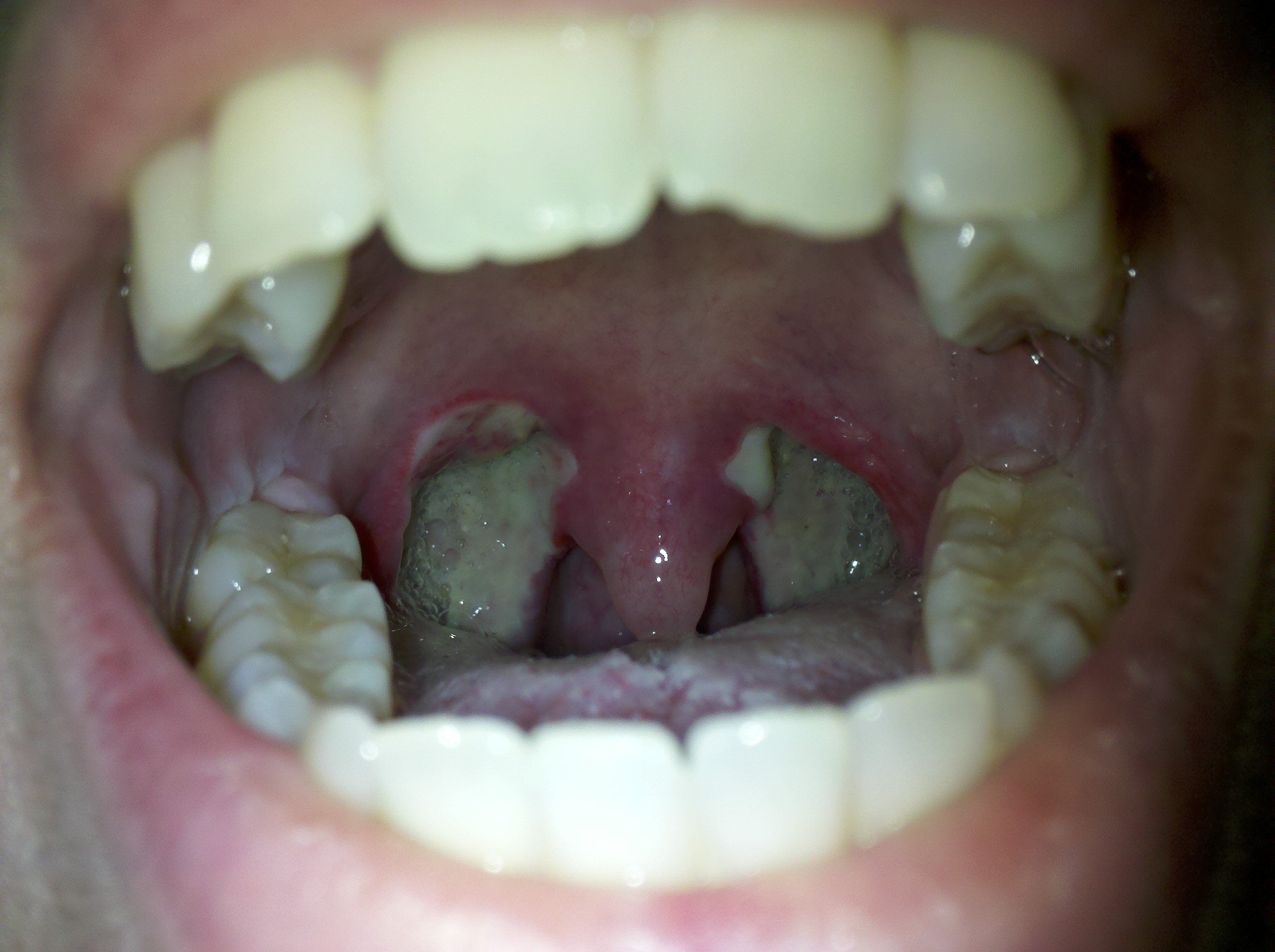 Is It Normal For Your Tongue To Hurt After A Tonsillectomy