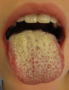 Oral thrush after tonsillectomy