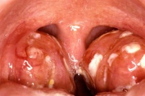 Tonsillectomy Pictures