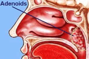 Adenoids and Adnenoidectomy