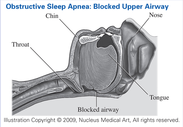 Obstructive Sleep Apnea Syndrome