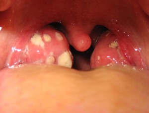 Tonsillitis pictures