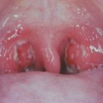tonsillitis picture