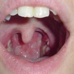 tonsillitis pictures