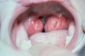 Swollen Tonsils