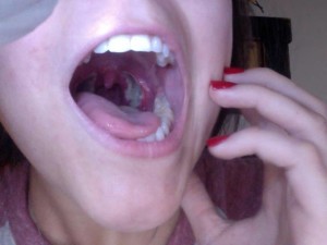Sore throat pictures viral