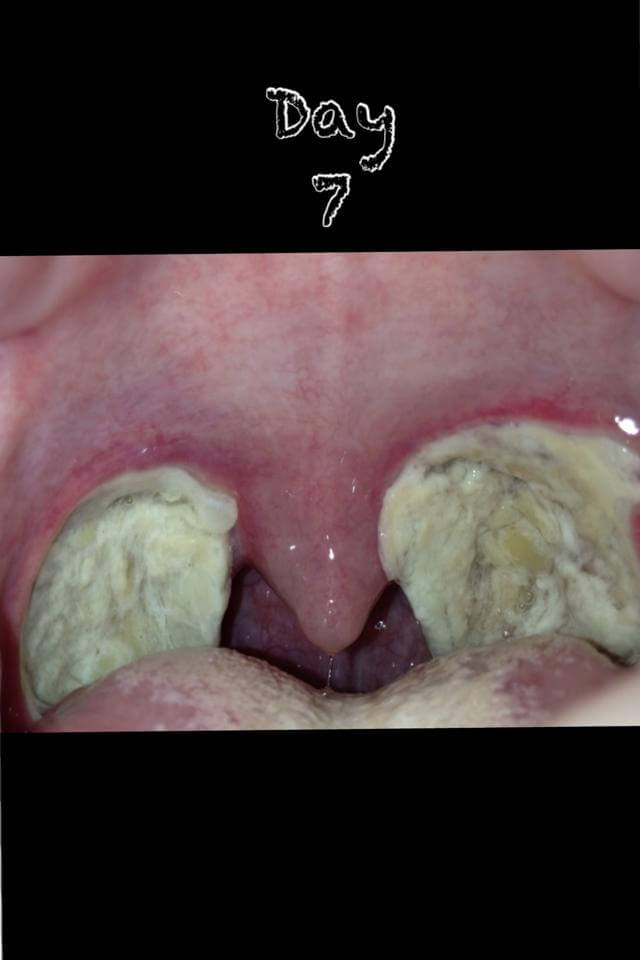 tonsillectomy scabs fall scab recovery around daily related