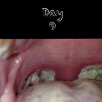 tonsillectomy day 9