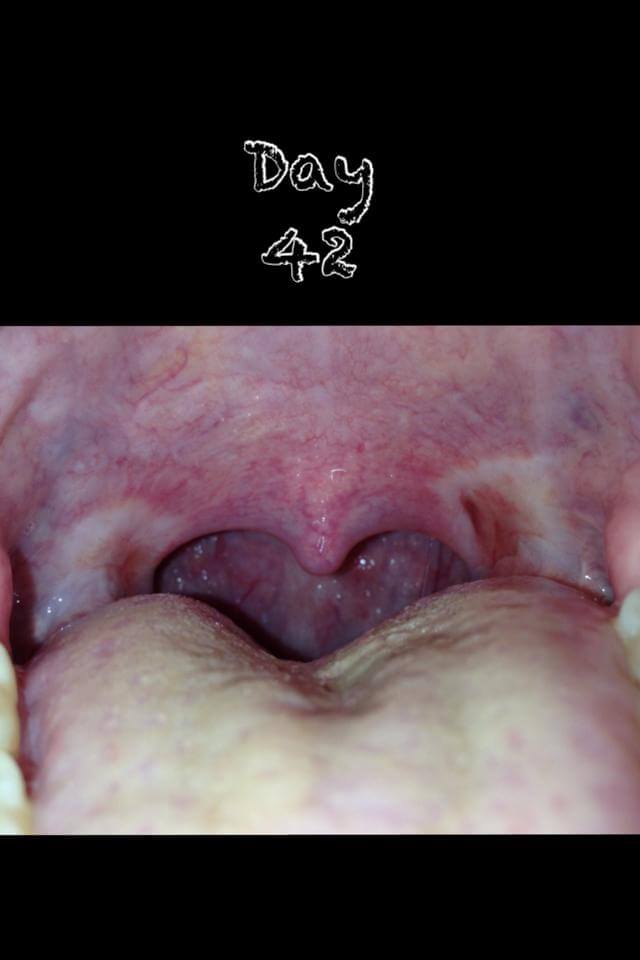 Tonsillectomy Day Recovery picture 42