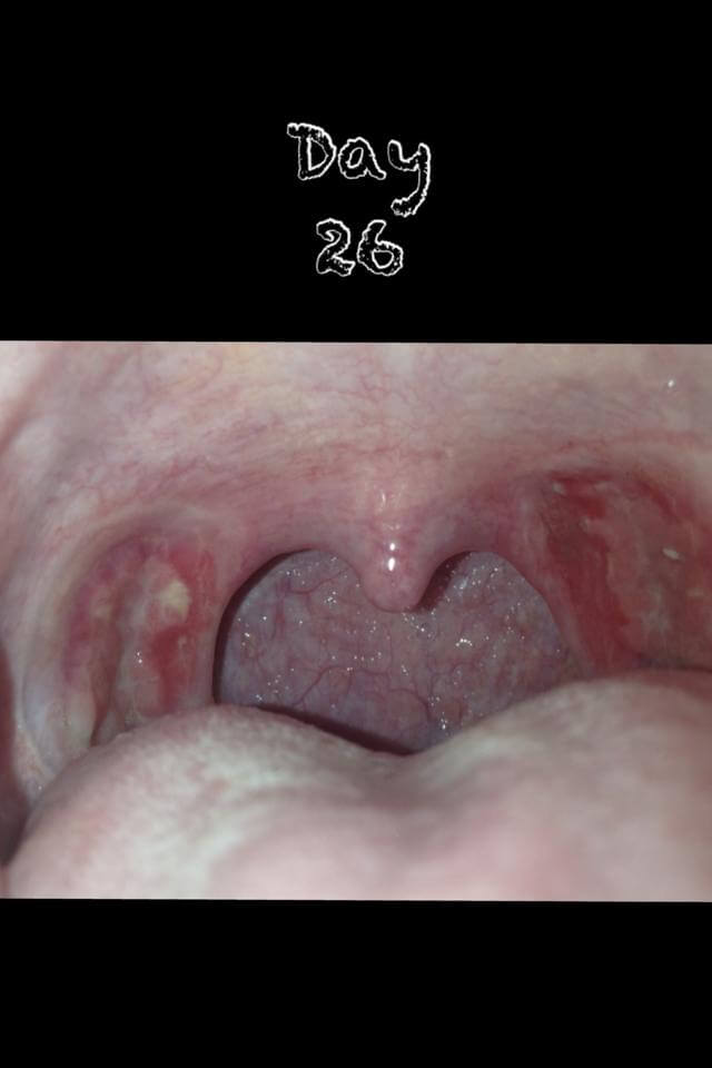 Tonsillectomy Recovery Photos Tonsillectomy - vrogue.co