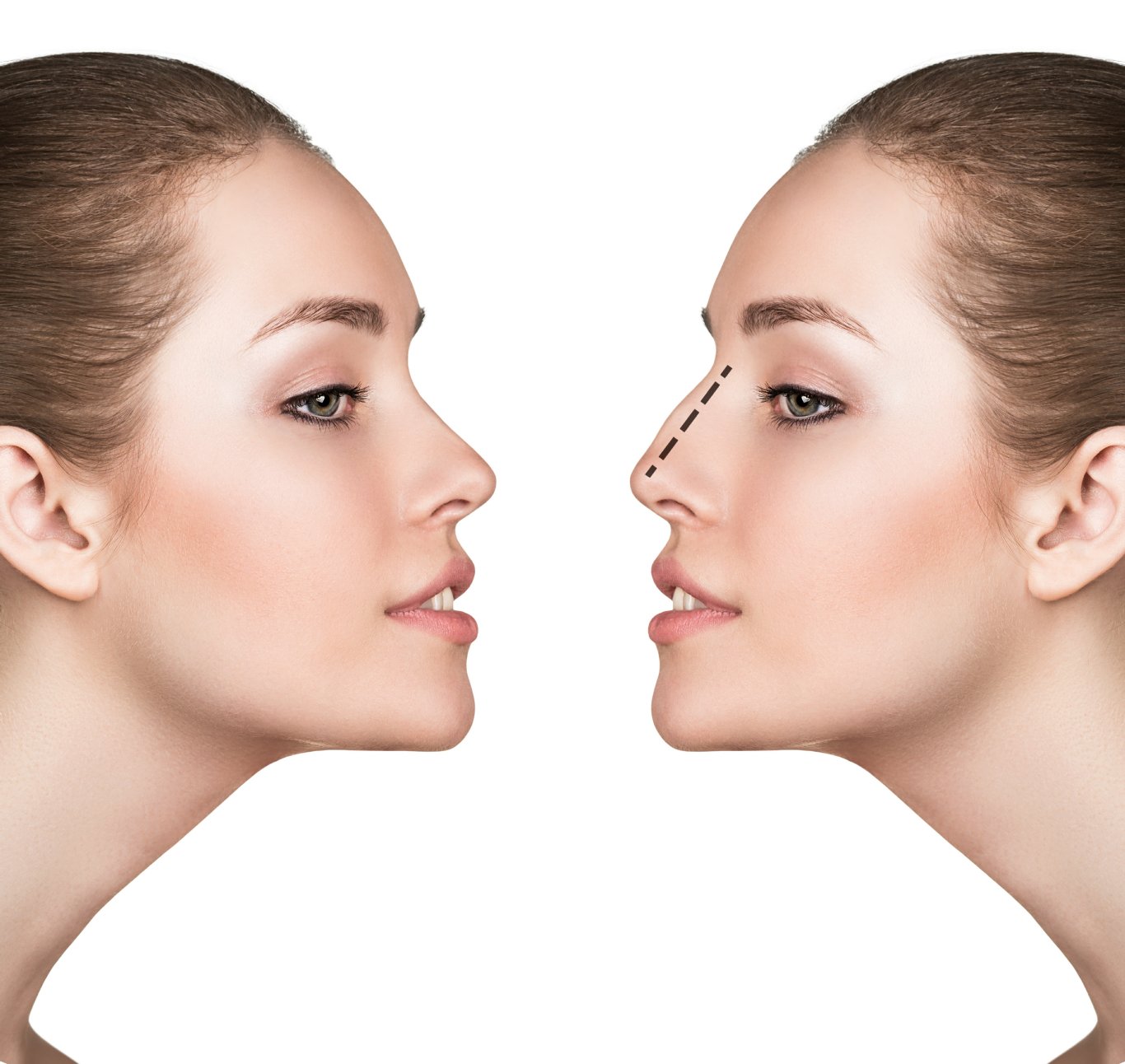 Rhinoplasty turbinate reduction Septoplasty