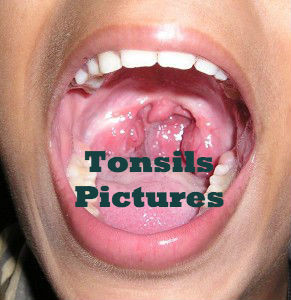 tonsils pictures