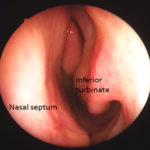 turbinate and septoplasty surgery