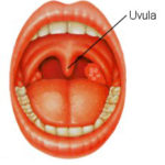 UPPP or Uvulectomy for sleep apnea and snoring