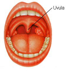 UPPP or Uvulectomy for sleep apnea and snoring